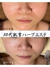 サロン ド エン(Salon de. en)/肌荒れケア◇ハーブピーリング