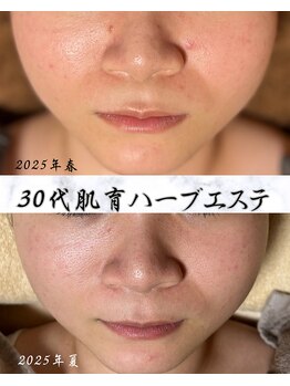 サロン ド エン(Salon de. en)/肌荒れケア◇ハーブピーリング