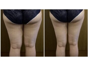 アリス 赤坂/太もも8カップ 7回