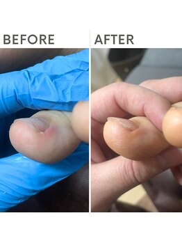 クオッカ(Quokka)/巻き爪ケア