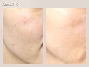 ラウン 京都(ROUN')/8回の施術ビフォーアフター