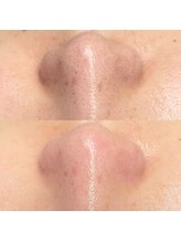 ティーティービューティー(TT Beauty)/毛穴専門だからできる事♪