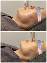 アンベール(unveil)/小顔