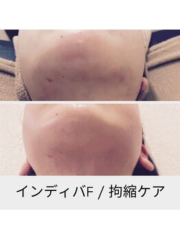 リムビューティー 自由が丘(RymBeauty)/美容施術後のむくみも穏和