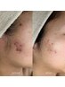 【人気NO.2頑固なニキビケア】最先端細胞美容ハーブピーリング￥15400→