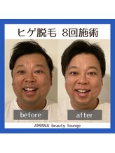 アマナ(AMANA)/ボールボーイ佐竹さん脱毛8回目