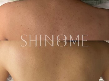 シノノメ(SHINONOME)/*背中ニキビケア