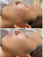 アンジェロ/【ニキビケア】肌育プログラム