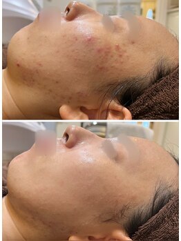 アンジェロ/【ニキビケア】肌育プログラム