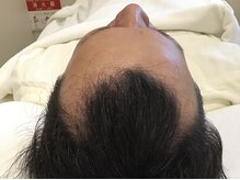 イーズ/リバイタ グランツリー武蔵小杉店/【ケース1】40代男性　before