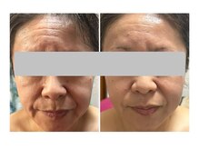 レジュイール(Rejouir)/タイムロックプログラム施術