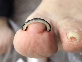 爽快の写真/【巻き爪を改善したい方へ！】短時間&痛みの少ない「爪フラ法」で自分の指に合った最適な爪の形に◎