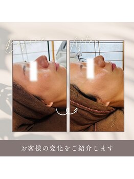 ルーク(Luke)/ビフォーアフター