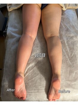 メイ 葛西(Mei)/Wマシンで1回だけ施術です。