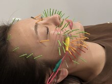 ソラナ(Solana)/美容鍼【100本】百華鍼