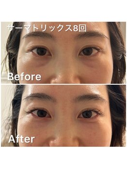 デディア 恵比寿(dedia)/目元のクマをなかったことに