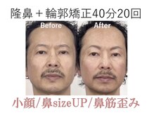 ラプリボヤージュ 藤沢店(Raplit)/ 隆鼻＋輪郭矯正40分20回