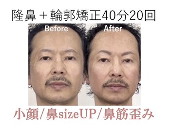 ラプリボヤージュ 藤沢店(Raplit)/ 隆鼻＋輪郭矯正40分20回