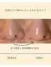 【OPEN記念☆究極の毛穴対策】洗浄×美容液導入のWケアでたるみ毛穴も改善♪