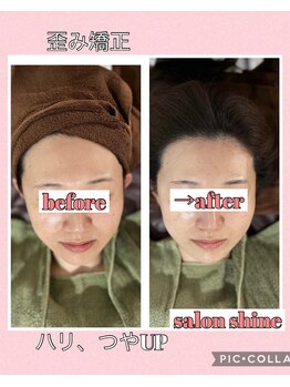 サロンシャイン(Salon Shine)/REVIハーブピーリング４０代女性