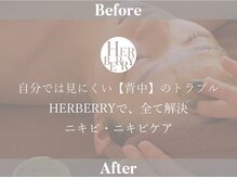 ハーバリー ハーブピーリング 大阪梅田店(HERBERRYハーブピーリング)/梅田ハーブピーリングHERBERRY