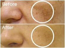 ラウレア(LAULEA)/スキンケア改善Before/After