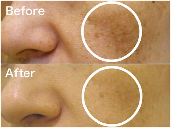 ラウレア(LAULEA)/スキンケア改善Before/After