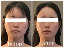 リジュ(Reju)/ブライダル！ハイパーナイフ小顔