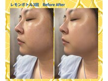 ピュアスキンサロン 恵比寿店(pure skin salon)/レモンボトル