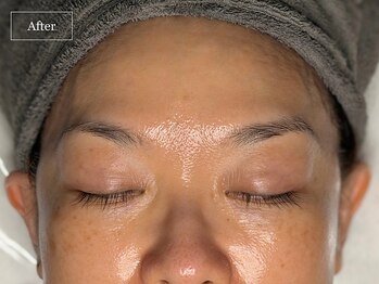 キュレイテッドスキン(CURATED SKIN)/ピーリング/毛穴ケア/肌質改善