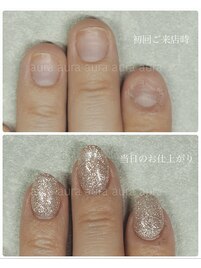 深爪矯正スカルプ長さだし/enoi