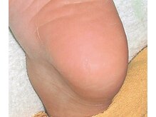 角質フットケアサロン リラックスパーク 大阪難波店(RelaxPark)/足裏角質除去でツルツル踵に！！