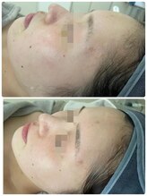 ファーファラ(Farfalla)/フォトIPLフェイシャル