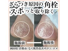 エメ(Aimer)/最新毛穴ケア