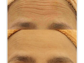 ファニービー 吹田店/40代 シワ 6ヶ月で改善