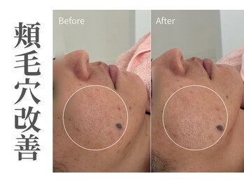 エトレ(etre)/毛穴改善/開き毛穴/たるみ毛穴