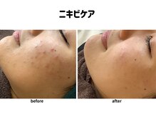 パールプラス 日田店/高密度超音波ソノケア