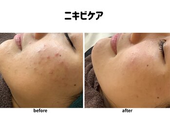 パールプラス 日田店/高密度超音波ソノケア