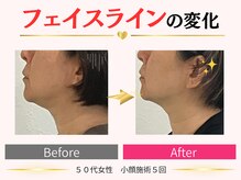 タイナ(taina)/50代女性/小顔施術5回
