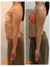 リール 新宿店(RIRE)/40代前半　バストアップ症例