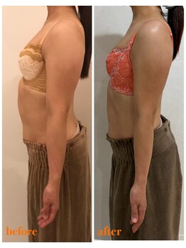 リール 新宿店(RIRE)/40代前半 バストアップ症例