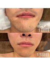 ミスト(MISTO)/【メンズ脱毛】