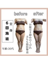 ラウレア(Laure'a)/ハイパーEX／シェイプ／ラドン