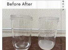 エミナル(EMINAL)/ハイドラフェイシャル