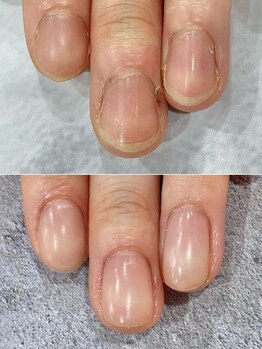 リファーレ(RIFARE)/【深爪矯正】現役介護士さん