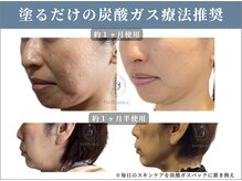 究極の炭酸パックを塗るだけ美容【長野/小顔矯正/たるみ/整体】