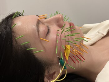 ソラナ(Solana)/美容鍼【100本】百華鍼