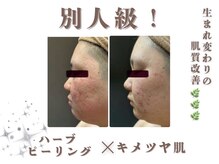 エステティック レイビス 銀座店(RAYVIS)/ハーブピーリング