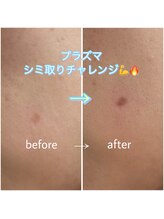 エラ(Ella)/プラズマシミケア