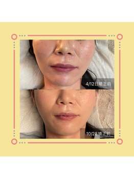 美容整体サロン プライム(Prime)/小顔矯正　ビフォーアフター